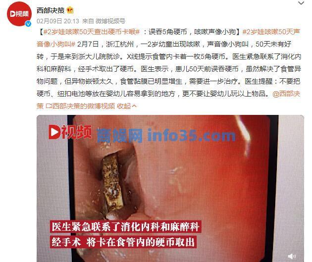 2岁娃咳嗽50天查出硬币卡喉:误吞5角硬币,咳嗽声像小狗。